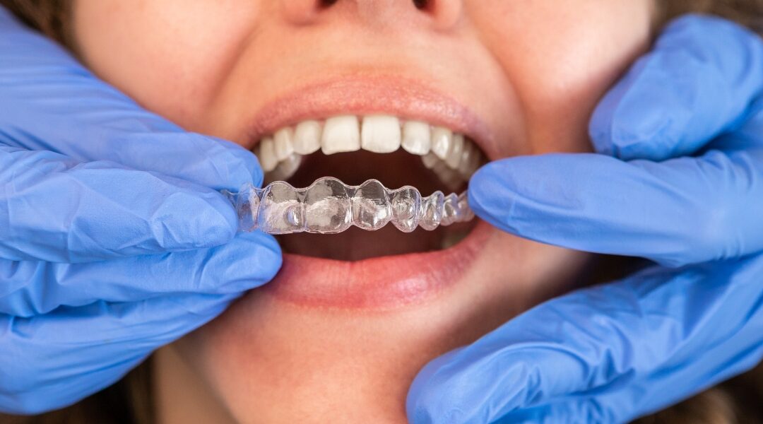 #1 Gold Invisalign Dentist in Frankfort: Your Best Smile