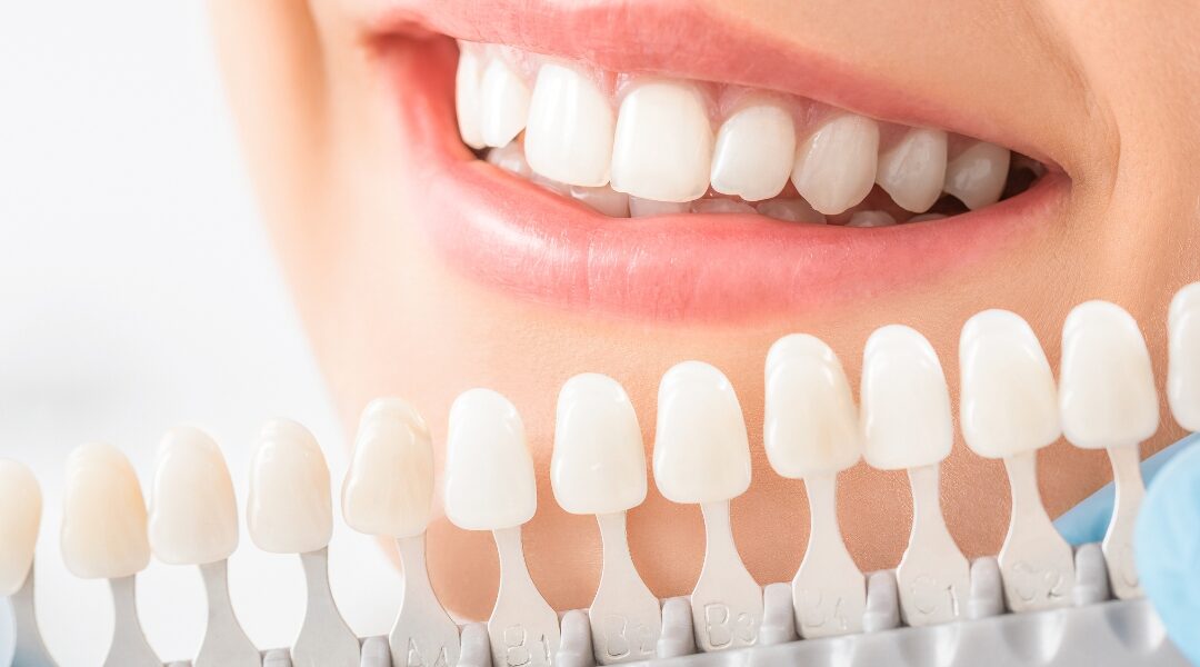 Dental Crowns Before and After: A Comprehensive Guide