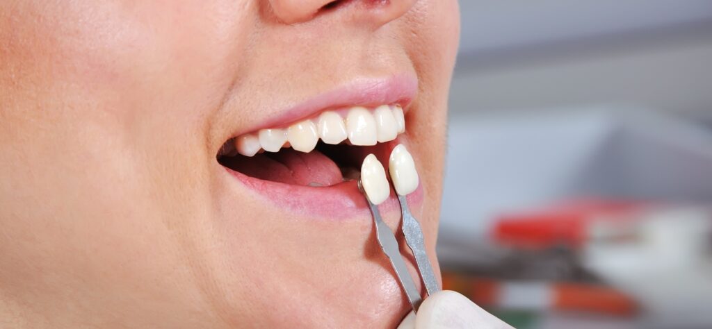 Dental Crowns Before and After