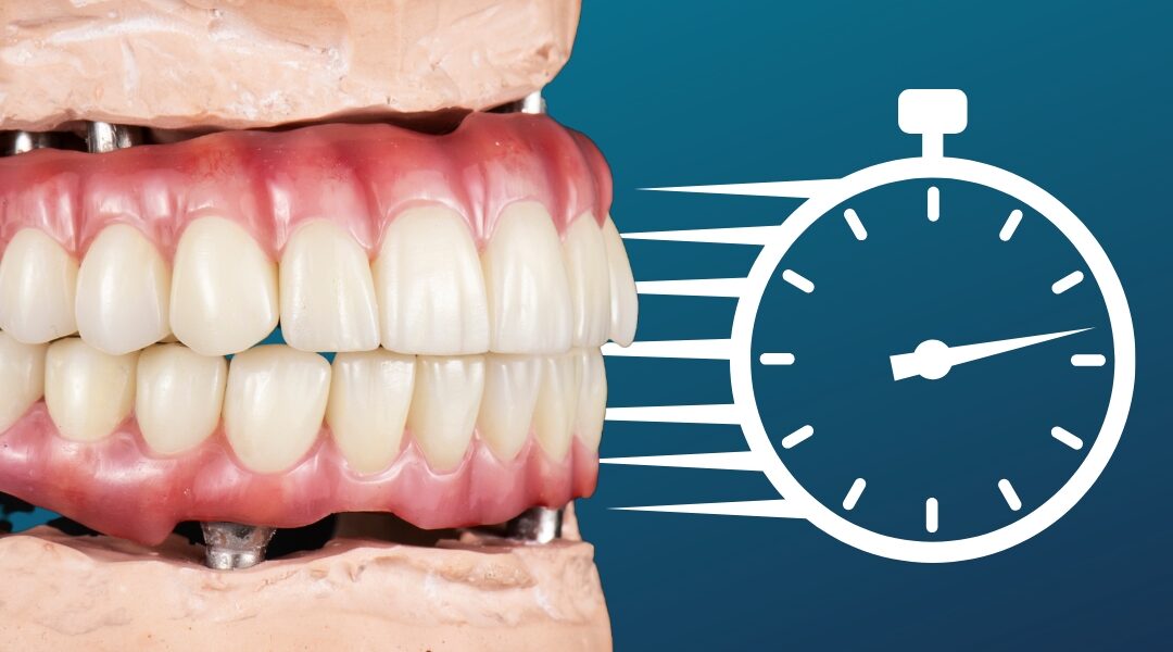 How Long Do All on 4 Implants Last? Lifespan Explained