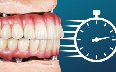 How Long Do All on 4 Implants Last? Lifespan Explained
