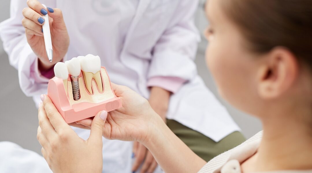 How to Clean All on 4 Dental Implants | Ultimate Care Guide