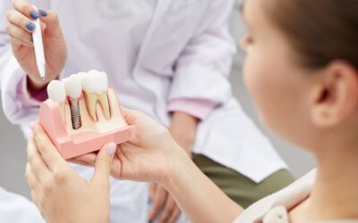 How to Clean All on 4 Dental Implants | Ultimate Care Guide