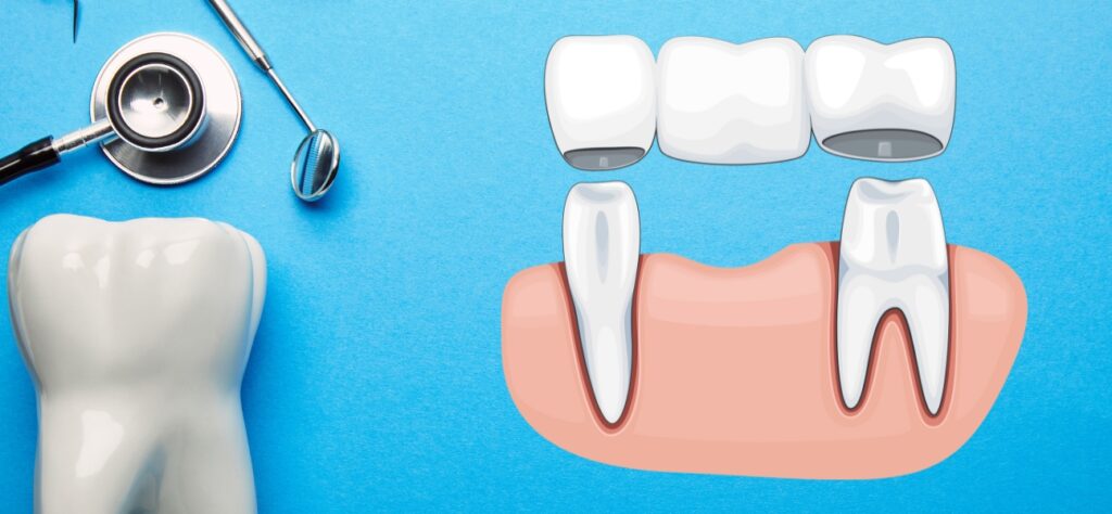 What is a Dental Crown