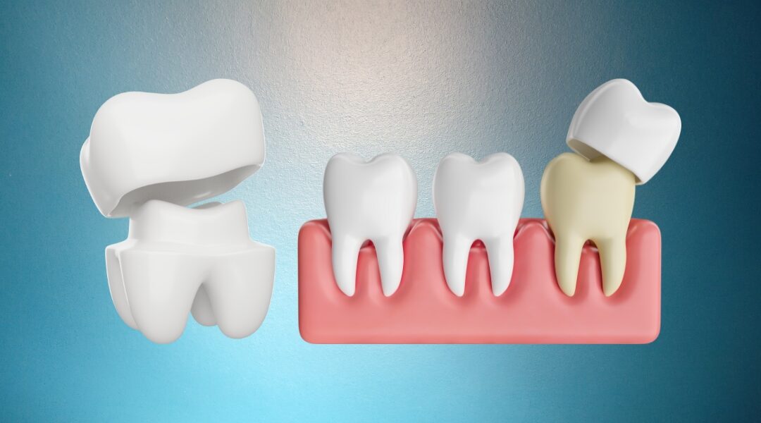 What Is A Dental Crown: A Clear Guide on Fixing Your Teeth
