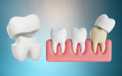 What Is A Dental Crown: A Clear Guide on Fixing Your Teeth