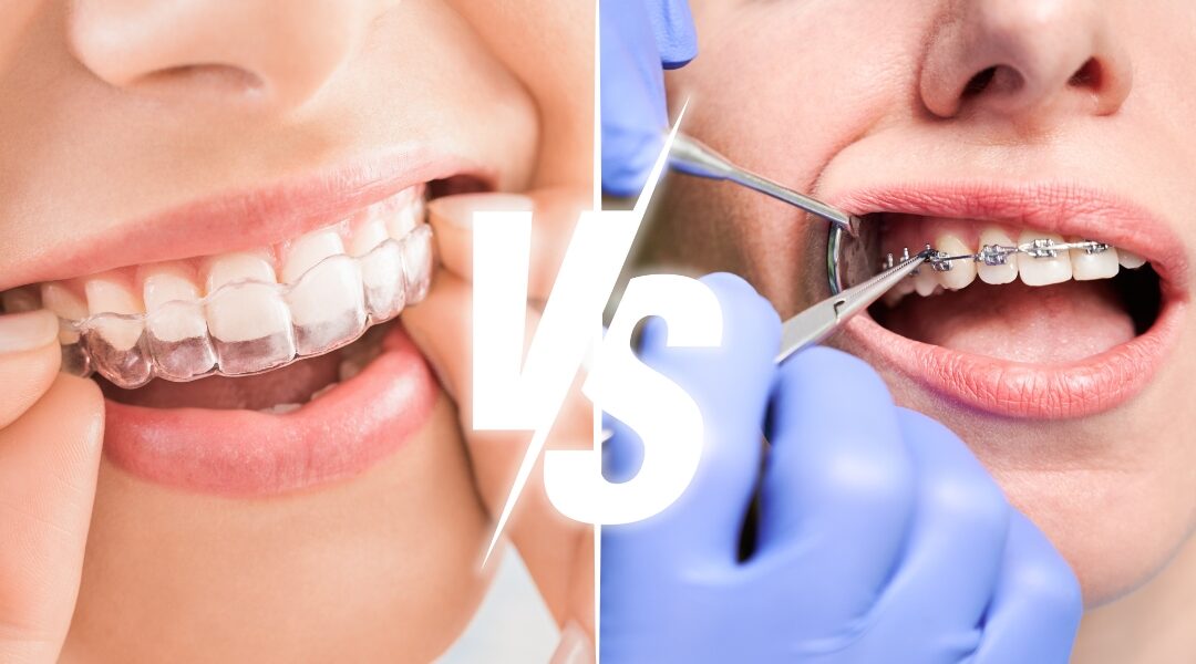 What Is Better Invisalign or Braces: Comparing Your Options
