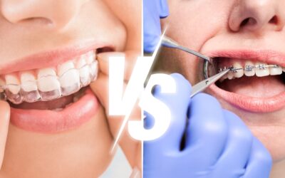 What Is Better Invisalign or Braces: Comparing Your Options